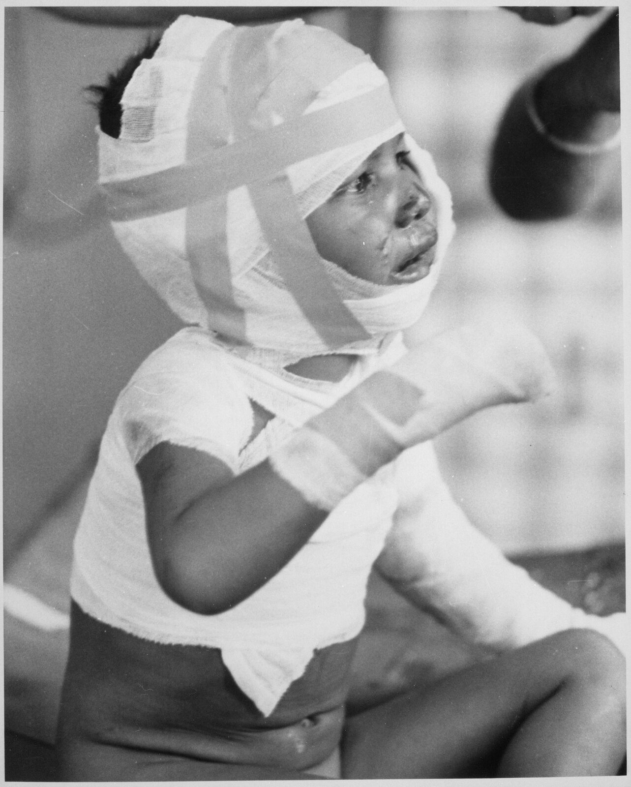 A small boy with his head, chest and arms bandaged, tears on his face